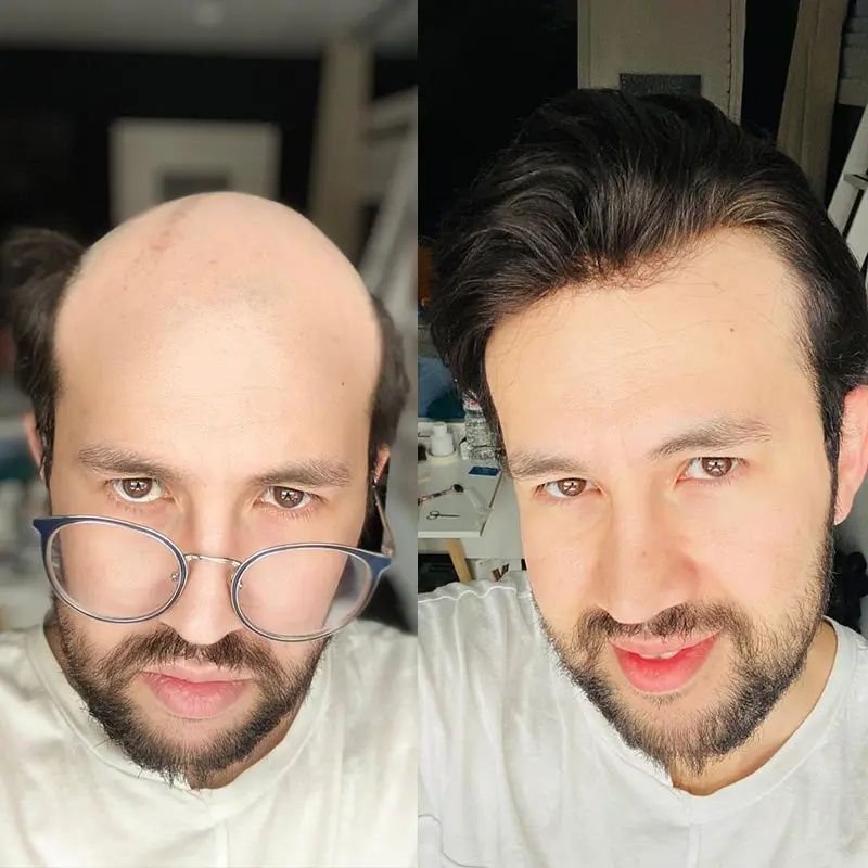 Hair system transformation